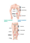 Symptome eines Lymphödems