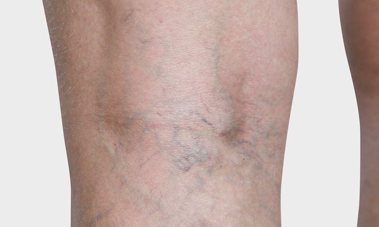 Spider veins