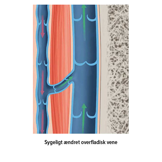 Sygeligt ændret overfladisk vene