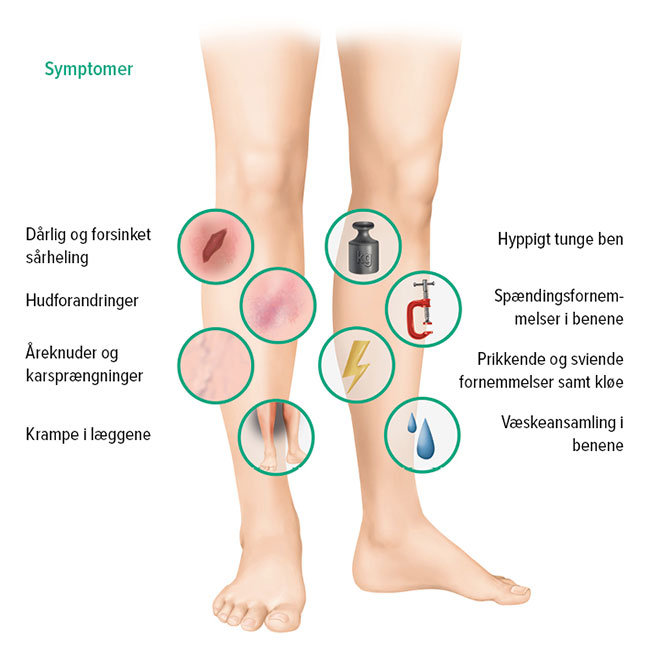 Symptomer for kronisk venøs insufficiens Symptomer for kronisk venøs insufficiens