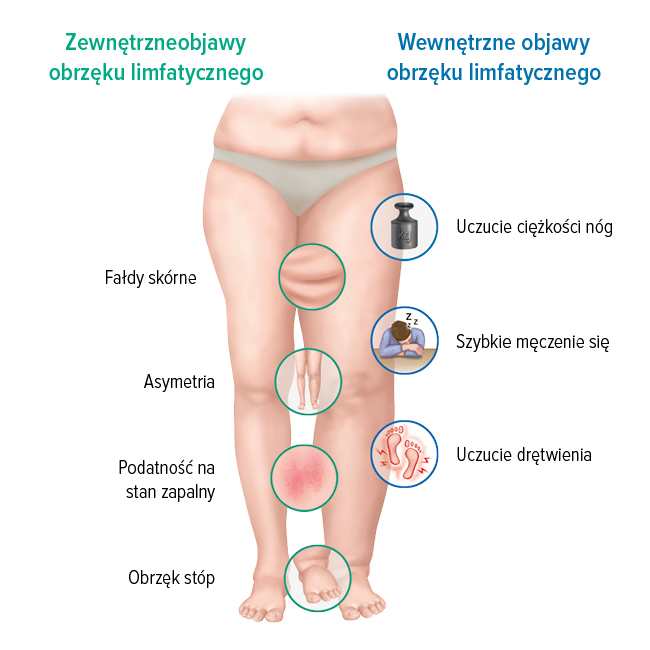 Objawy obrzęku limfatycznego