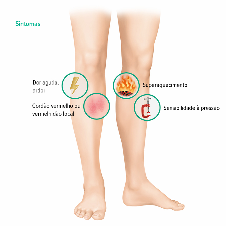 Sintomas de trombose venosa superficial (TVS) Sintomas de trombose venosa superficial (TVS)