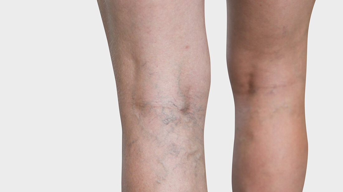 Beininnenseite, an der man Besenreiser sieht