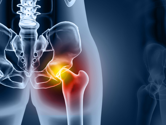 Radiografía azul de la cadera con marca en la zona de la cadera