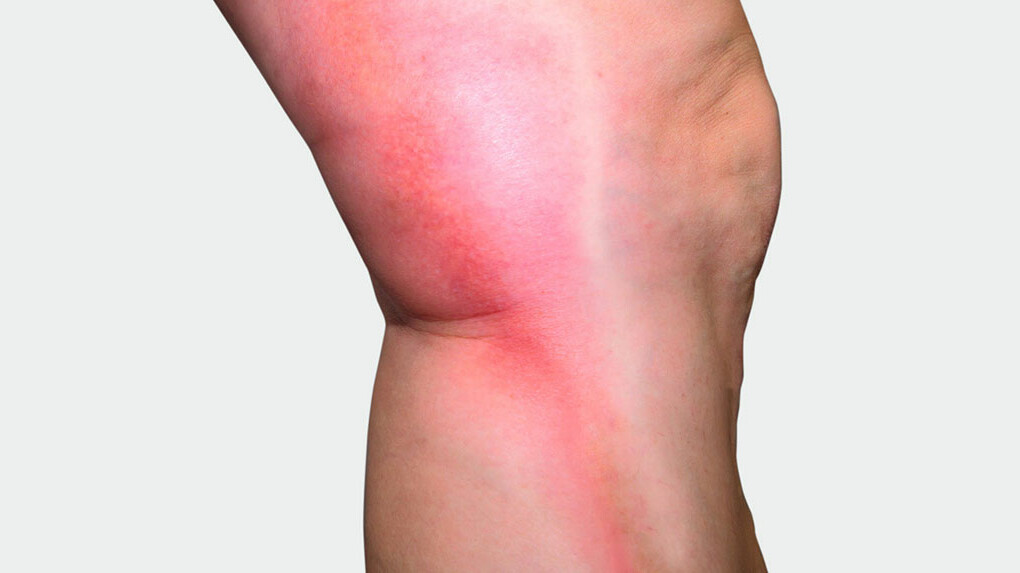 Mainteaser Thrombose Beine mit rotem Strang auf der Seite
