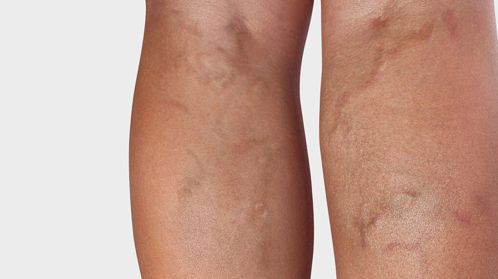 Arrière de la jambe, où l'on voit des varices Arrière de la jambe, où l'on voit des varices