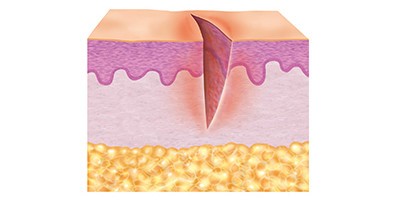 Abbildung Hautschichten in Reinigungsphase