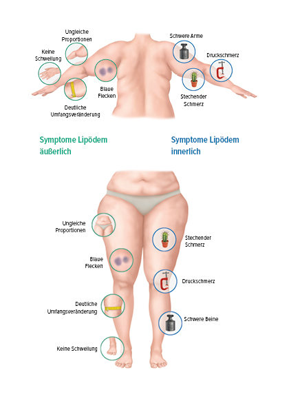 Alles was Sie über das Lipödem wissen sollten - Juzo