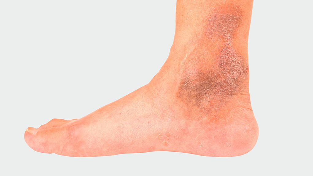 Sample image of chronic venous insufficiency Sample image of chronic venous insufficiency