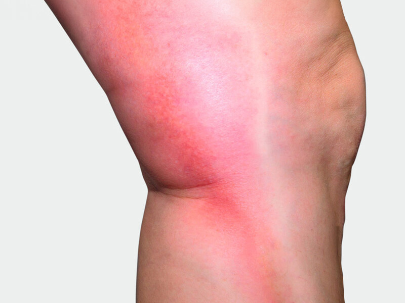 L'intérieur de la jambe, où l'on observe une coloration rouge