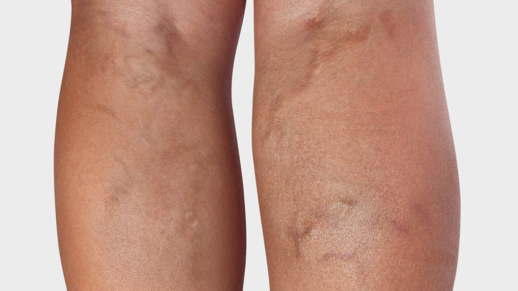 Arrière de la jambe, où l'on voit des varices Arrière de la jambe, où l'on voit des varices