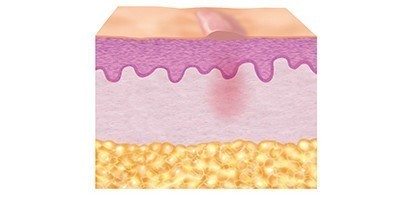 Abbildung Hautschichten in Reparationsphase