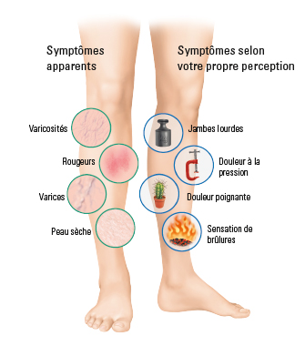 varices internes jambes symptômes)