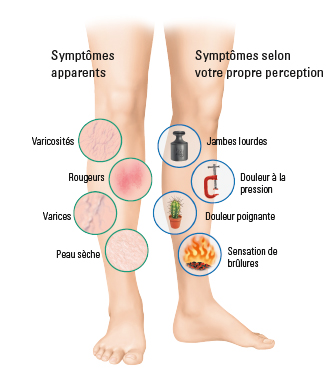 varices douloureuses et gonflées