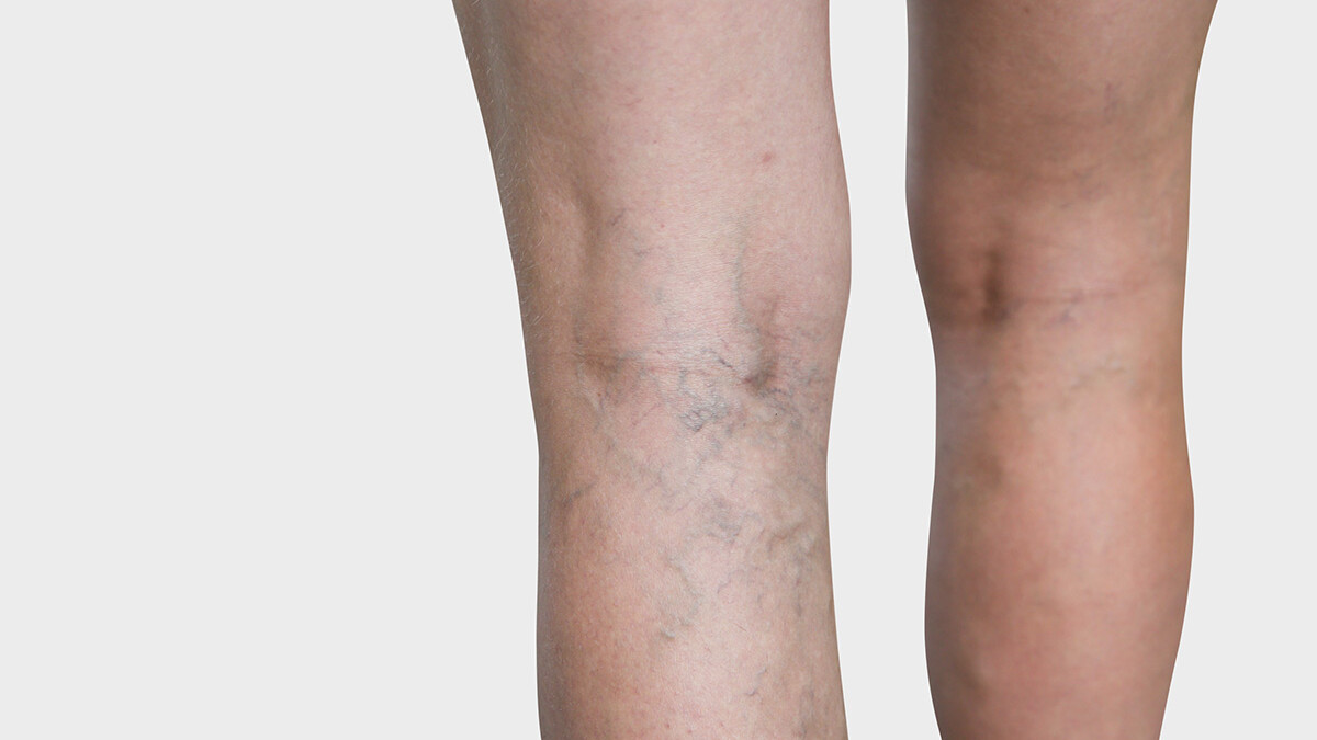 The inner side of the leg, where spider veins are visible The inner side of the leg, where spider veins are visible