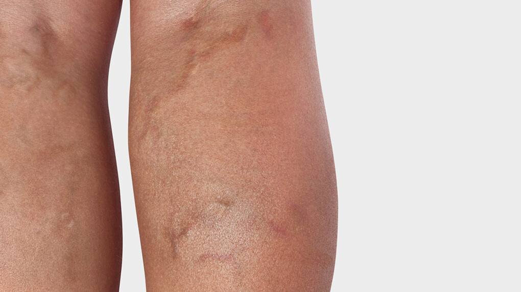 The back of the leg, where varicose veins are visible The back of the leg, where varicose veins are visible