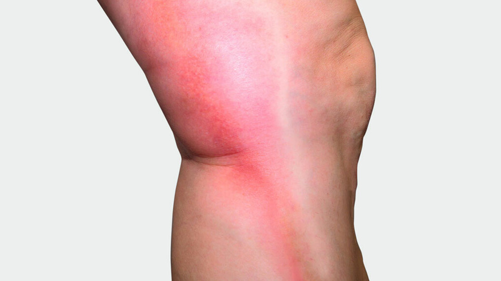 Mainteaser Thrombose Beine mit rotem Strang auf der Seite