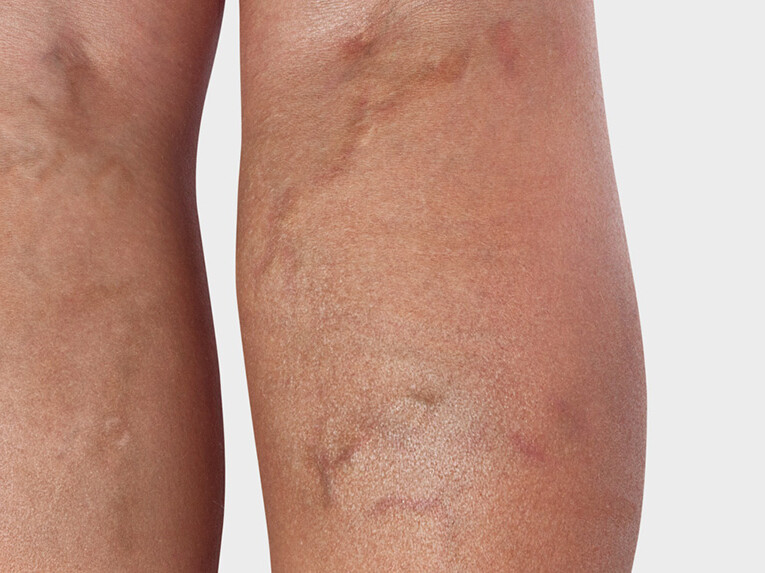 The back of the leg, where varicose veins are visible