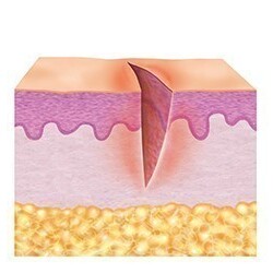 1. Hudens inflammationsfas (rengöringsfas) 1. Hudens inflammationsfas (rengöringsfas)