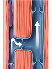 oberflächliche Venenthrombose