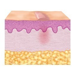3. Reparatiefase (epithelisatie) 3. Reparatiefase (epithelisatie)