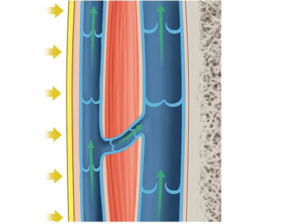 Ven med kompression Ven med kompression