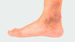 Jambe Avec IVC