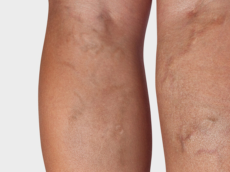 Arrière de la jambe, où l'on voit des varices Arrière de la jambe, où l'on voit des varices
