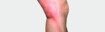 Bein mit Thrombose Symptomen