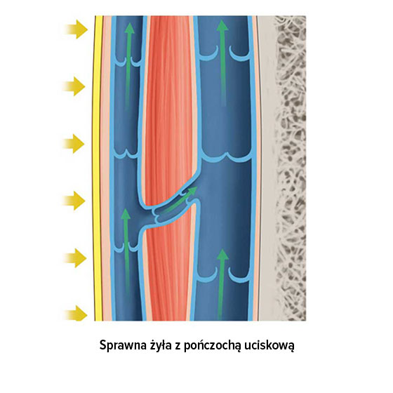 Sprawna żyła z pończochą uciskową