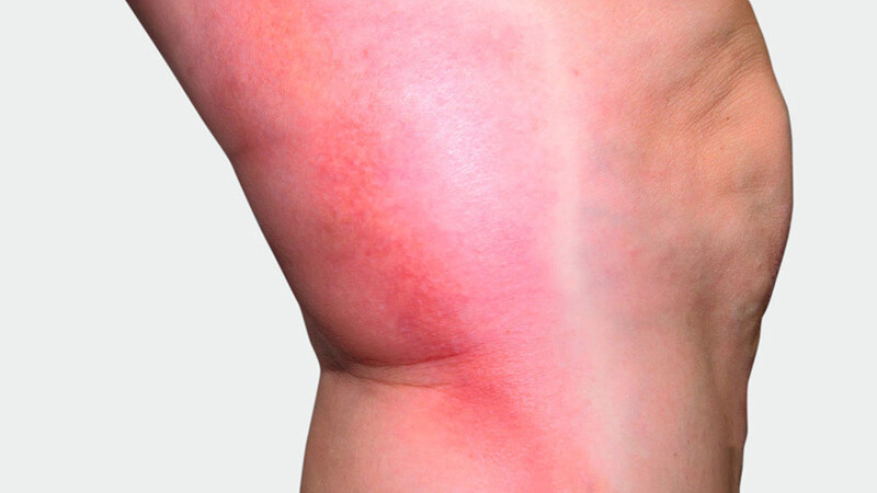 The inner side of the leg, where red discoloration is visible The inner side of the leg, where red discoloration is visible