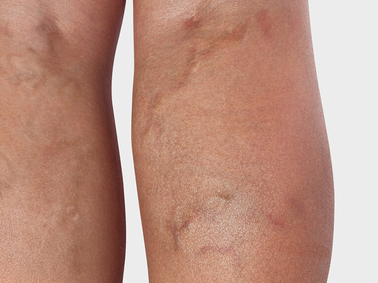 Arrière de la jambe, où l'on voit des varices