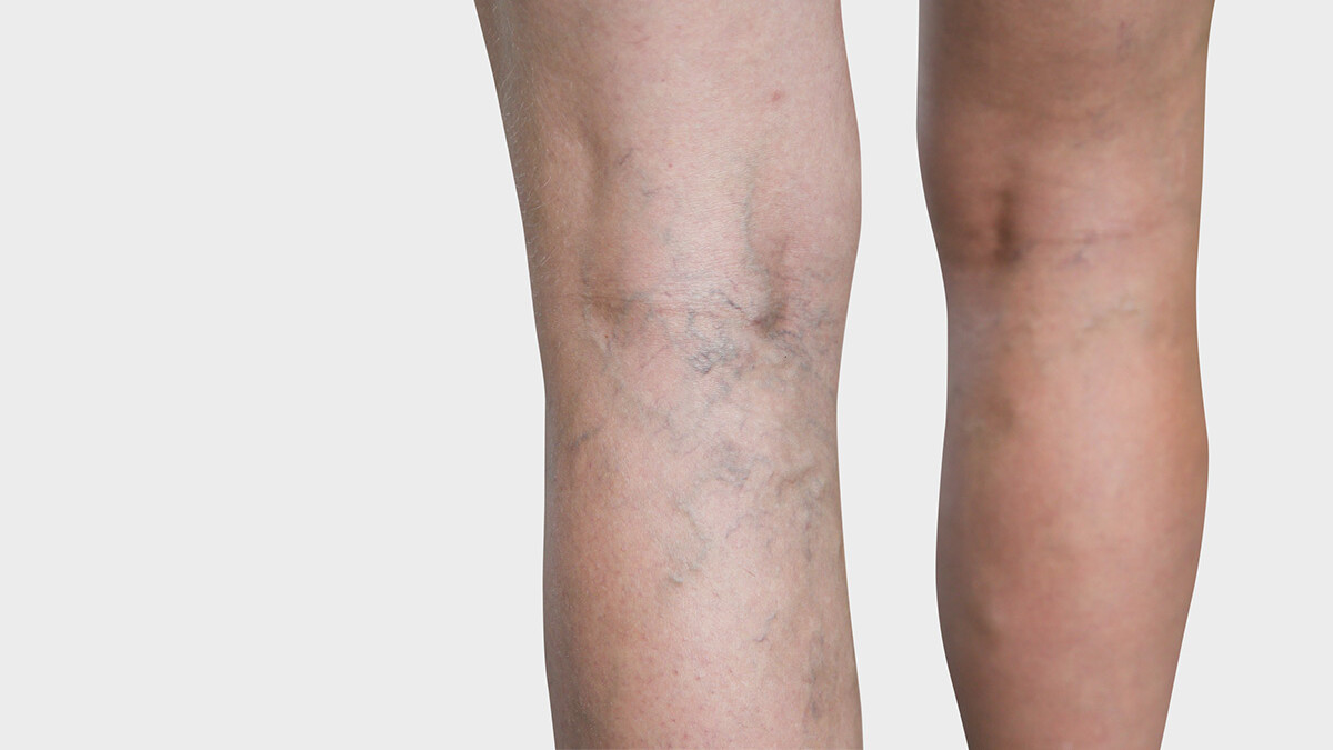 The inner side of the leg, where spider veins are visible The inner side of the leg, where spider veins are visible
