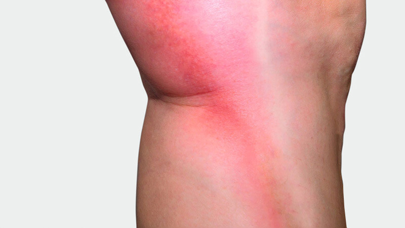 The inner side of the leg, where red discoloration is visible The inner side of the leg, where red discoloration is visible