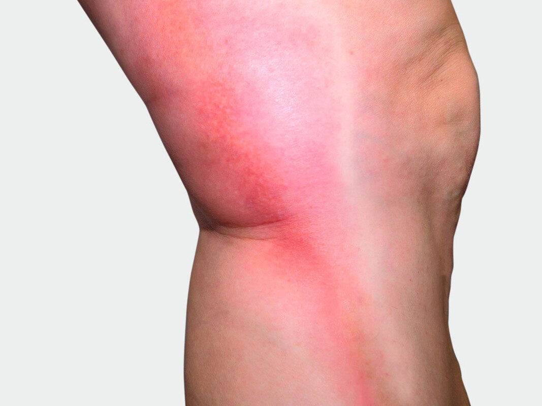 Intérieur de la jambe, où l'on observe une coloration rouge Intérieur de la jambe, où l'on observe une coloration rouge