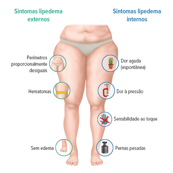Sintomas gráficos de lipoedema Sintomas gráficos de lipoedema