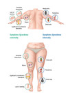 Diagram Lipoedema symptoms