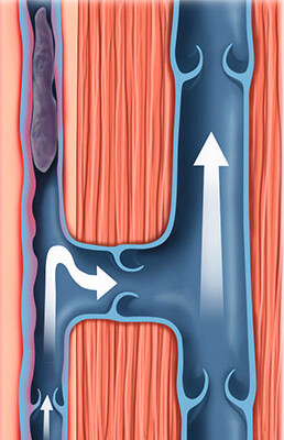oberflächliche Venenthrombose oberflächliche Venenthrombose