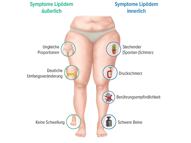 Lipödem Symptome