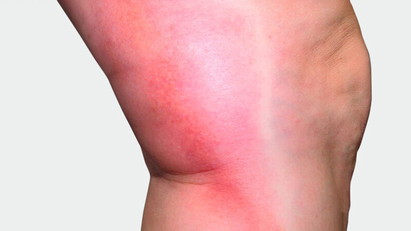 The inner side of the leg, where red discoloration is visible The inner side of the leg, where red discoloration is visible