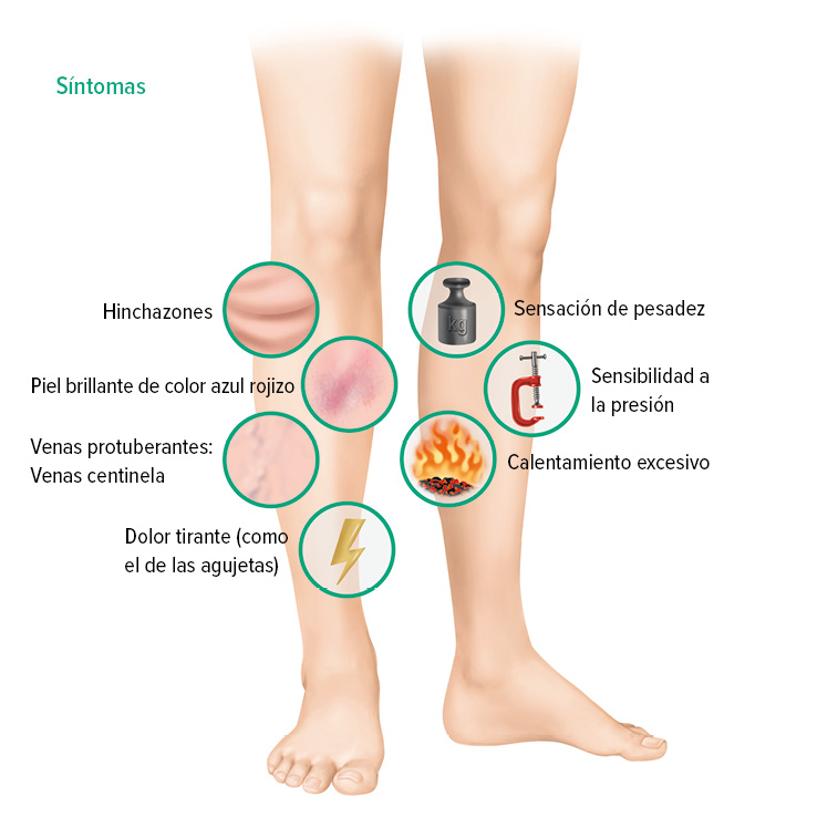 Síntomas de la trombosis venosa profunda
