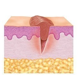 2. Nybildningsfas (proliferationsfas) 2. Nybildningsfas (proliferationsfas)