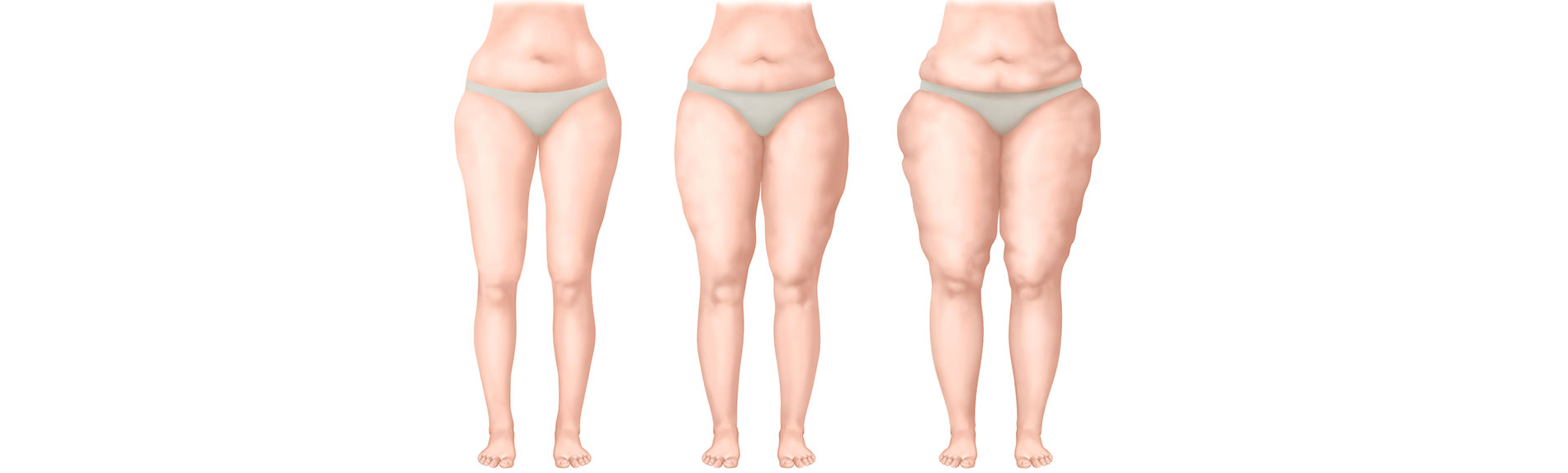 Alles was Sie über das Lipödem wissen sollten