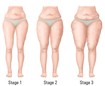 Diagram showing the stages of lipoedema
