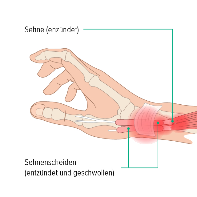Anatomie einer Sehnenscheidenentzündung Auf dieser Grafik erkennt man die Anatomie einer Hand, die Sehnen verlaufen durch Sehnenscheiden in der Hand