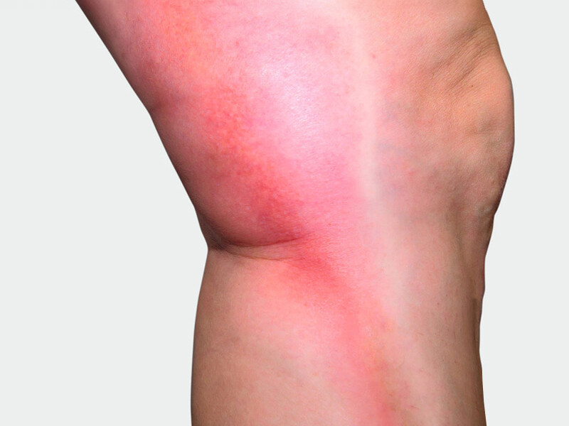 The inner side of the leg, where red discoloration is visible