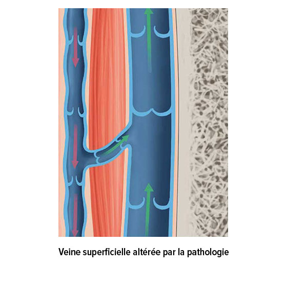 Veine superficielle pathologiquement altérée
