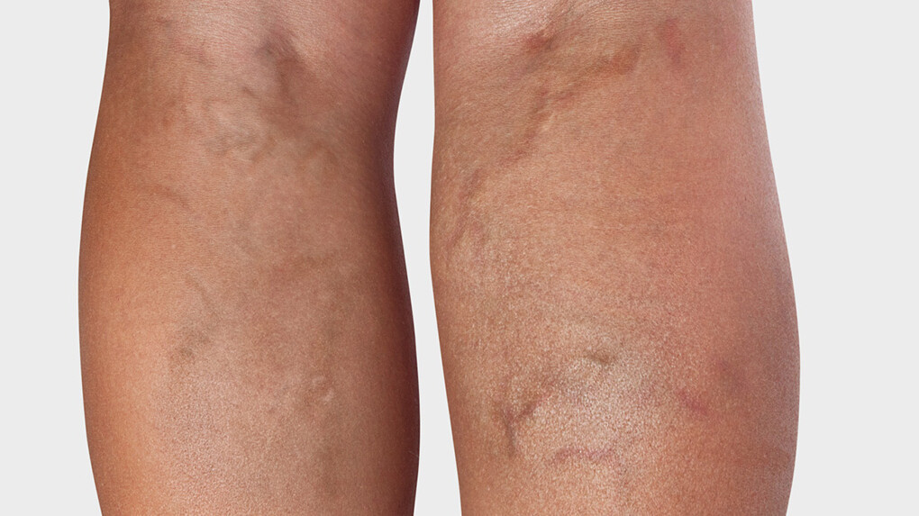 Arrière de la jambe, où l'on voit des varices