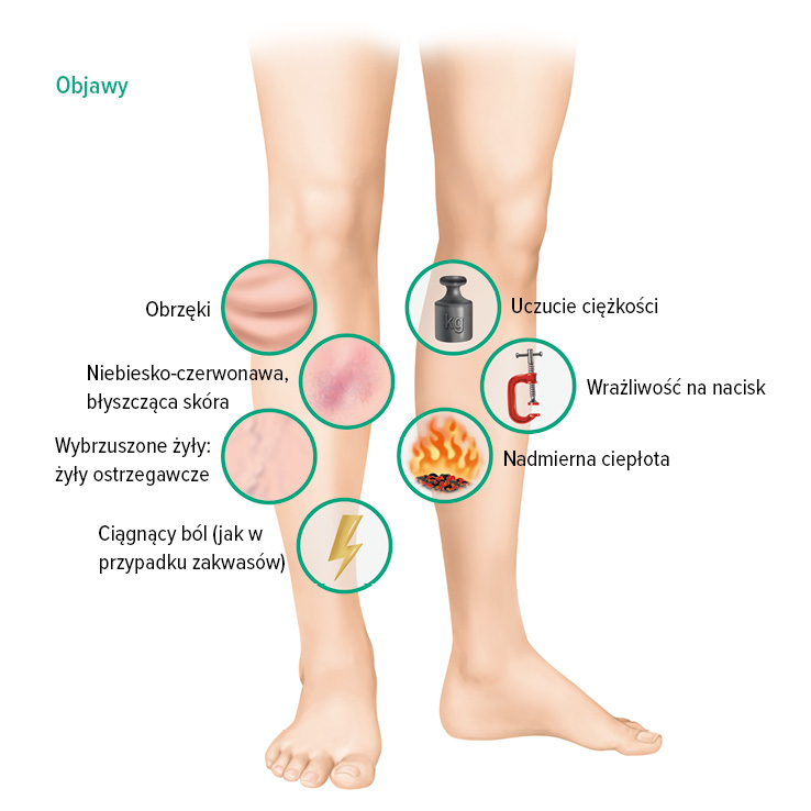 Objawy zakrzepicy żył głębokich