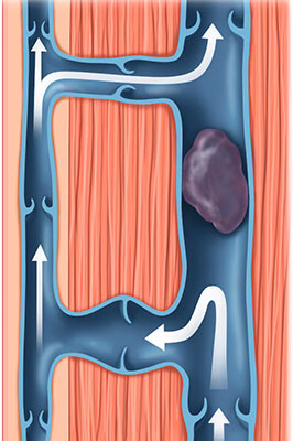 tiefe Beinvenenthrombose tiefe Beinvenenthrombose
